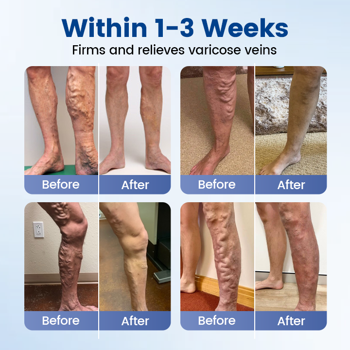 Alisanda® Vein Ease Microneedle Therapy Patch - Fast ⚡Effective 💪 and Non-Invasive 🚫 Treatment for Varicose Veins & Leg Swelling 👣