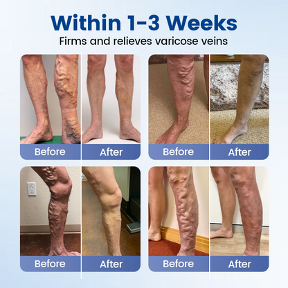 Alisanda® Vein Ease Microneedle Therapy Patch - Fast ⚡Effective 💪 and Non-Invasive 🚫 Treatment for Varicose Veins & Leg Swelling 👣