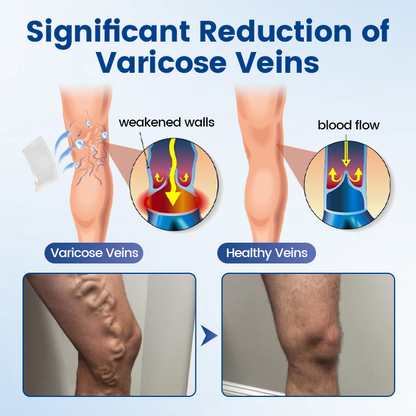 Alisanda® Vein Ease Microneedle Therapy Patch - Fast ⚡Effective 💪 and Non-Invasive 🚫 Treatment for Varicose Veins & Leg Swelling 👣