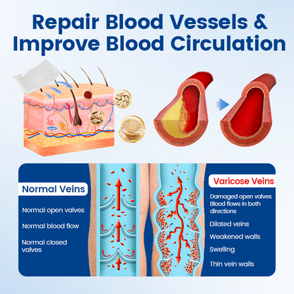 Alisanda® Vein Ease Microneedle Therapy Patch - Fast ⚡Effective 💪 and Non-Invasive 🚫 Treatment for Varicose Veins & Leg Swelling 👣